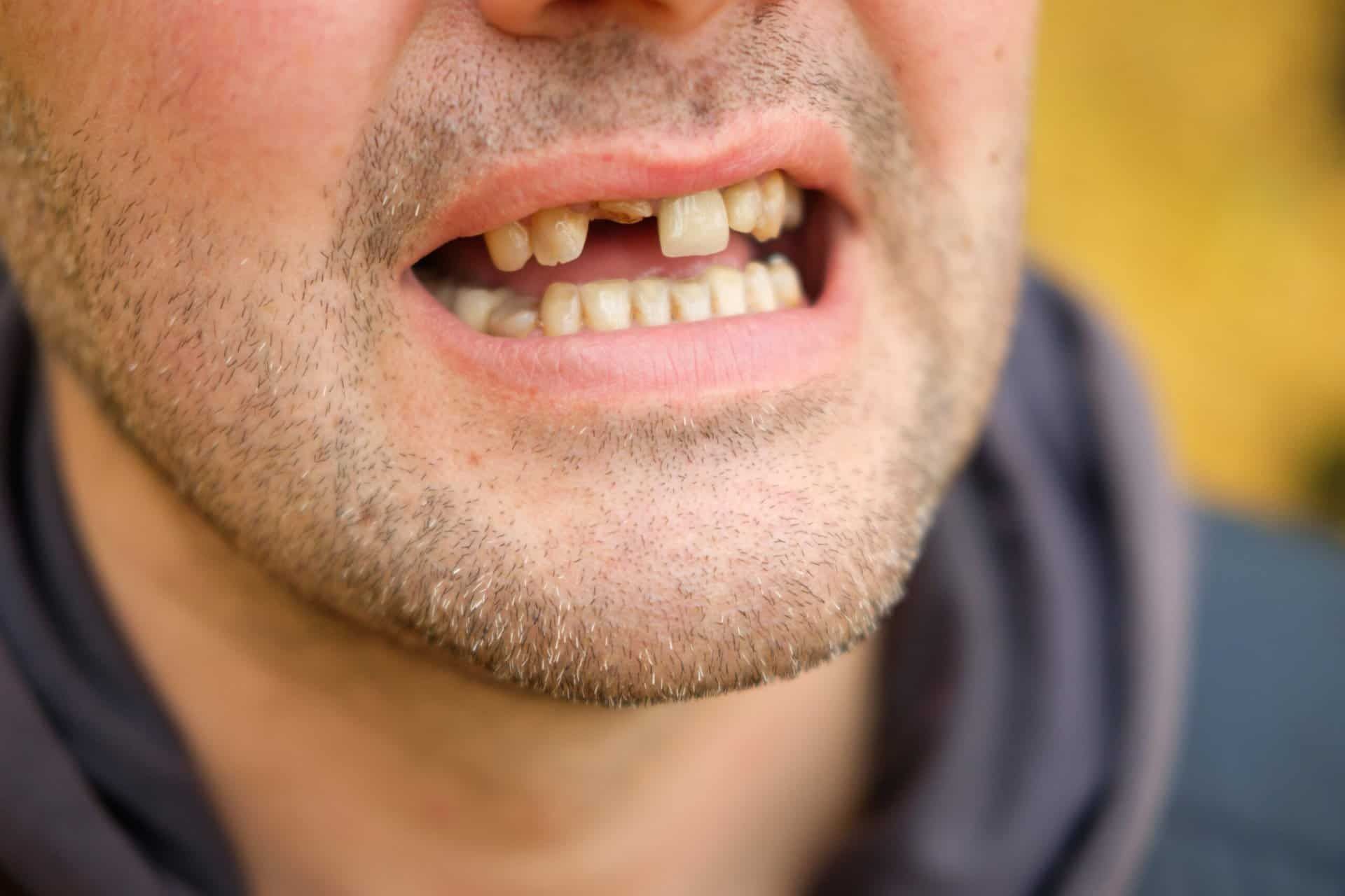 meth mouth